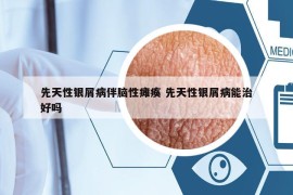 先天性銀屑病伴腦性癱瘓 先天性銀屑病能治好嗎