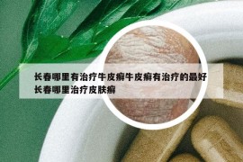 長春哪里有治療牛皮癬牛皮癬有治療的最好 長春哪里治療皮膚癬