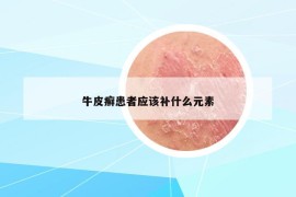 牛皮癬患者應該補什么元素