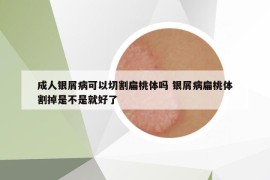 成人銀屑病可以切割扁桃體嗎 銀屑病扁桃體割掉是不是就好了