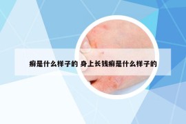 癬是什么樣子的 身上長(zhǎng)錢癬是什么樣子的