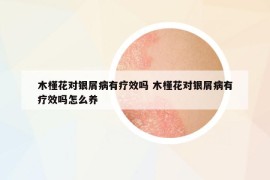 木槿花對銀屑病有療效嗎 木槿花對銀屑病有療效嗎怎么養(yǎng)