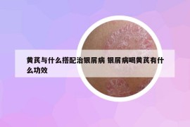 黃芪與什么搭配治銀屑病 銀屑病喝黃芪有什么功效