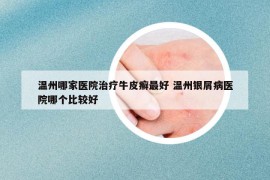 溫州哪家醫(yī)院治療牛皮癬最好 溫州銀屑病醫(yī)院哪個(gè)比較好