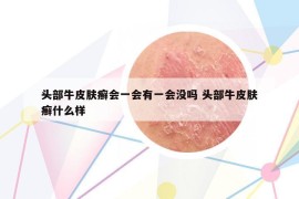 頭部牛皮膚癬會一會有一會沒嗎 頭部牛皮膚癬什么樣