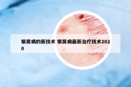 銀屑病的新技術 銀屑病最新治療技術2020