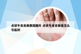 點(diǎn)狀牛皮皮癬原因圖片 點(diǎn)狀牛皮皮癬是怎么引起的