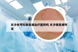 長沙有?？沏y屑病治療醫(yī)院嗎 長沙銀屑病專家