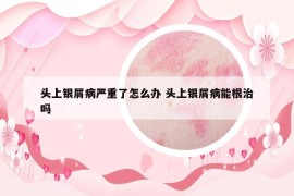 頭上銀屑病嚴重了怎么辦 頭上銀屑病能根治嗎