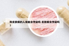 和皮膚癬的人接觸會傳染嗎 皮膚癬會傳染嗎?