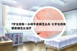 7歲女孩有一小塊牛皮癬怎么辦 七歲女孩有銀屑病怎么治療