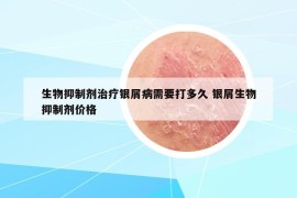 生物抑制劑治療銀屑病需要打多久 銀屑生物抑制劑價格