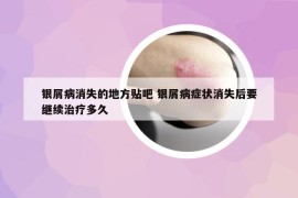 銀屑病消失的地方貼吧 銀屑病癥狀消失后要繼續(xù)治療多久