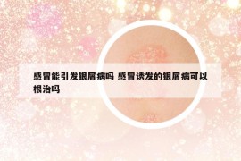 感冒能引發(fā)銀屑病嗎 感冒誘發(fā)的銀屑病可以根治嗎