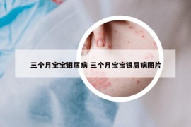 三個(gè)月寶寶銀屑病 三個(gè)月寶寶銀屑病圖片