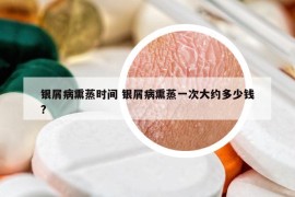 銀屑病熏蒸時間 銀屑病熏蒸一次大約多少錢?
