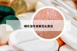 嶙片治牛皮癬怎么用法