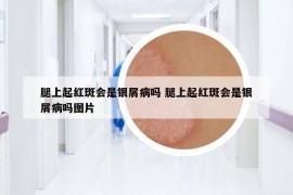 腿上起紅斑會是銀屑病嗎 腿上起紅斑會是銀屑病嗎圖片