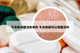 牛皮癬用醋泡有用嗎 牛皮膚癬可以用醋洗嗎