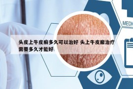 頭皮上牛皮癬多久可以治好 頭上牛皮廨治療需要多久才能好