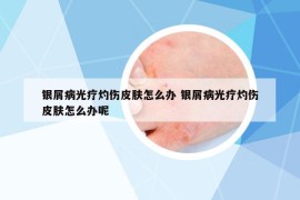 銀屑病光療灼傷皮膚怎么辦 銀屑病光療灼傷皮膚怎么辦呢