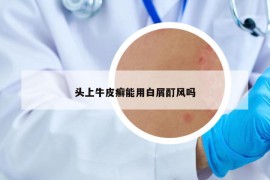 頭上牛皮癬能用白屑酊風(fēng)嗎