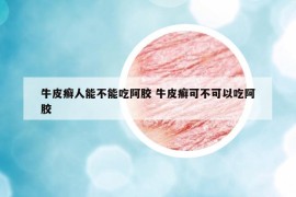 牛皮癬人能不能吃阿膠 牛皮癬可不可以吃阿膠
