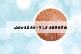 成都治銀屑病哪個(gè)醫(yī)生好 成都看銀屑病