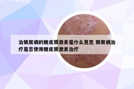 治銀屑病的糖皮質激素是什么意思 銀屑病治療是否使用糖皮質激素治療