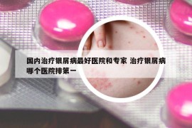 國(guó)內(nèi)治療銀屑病最好醫(yī)院和專(zhuān)家 治療銀屑病哪個(gè)醫(yī)院排第一