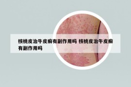 核桃皮治牛皮癬有副作用嗎 核桃皮治牛皮癬有副作用嗎