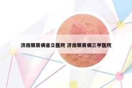 濟南銀屑病省立醫(yī)院 濟南銀屑病三甲醫(yī)院