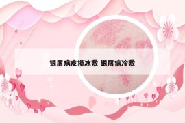 銀屑病皮損冰敷 銀屑病冷敷
