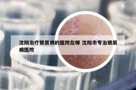 沈陽治療銀屑病的醫(yī)院在哪 沈陽市專治銀屑病醫(yī)院