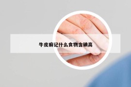 牛皮癬記什么食物含碘高