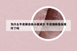為什么牛皮癬會血小板減少 牛皮病癬是血液壞了嗎