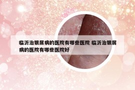 臨沂治銀屑病的醫(yī)院有哪些醫(yī)院 臨沂治銀屑病的醫(yī)院有哪些醫(yī)院好