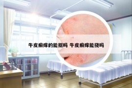 牛皮癬癢的能摳嗎 牛皮癬癢能撓嗎