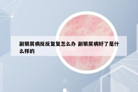 副銀屑病反反復(fù)復(fù)怎么辦 副銀屑病好了是什么樣的