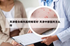 天津看白癜風(fēng)醫(yī)院哪家好 天津中都醫(yī)院怎么樣