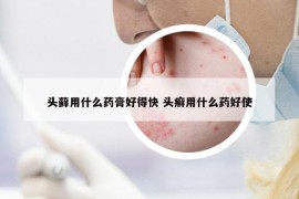 頭蘚用什么藥膏好得快 頭癬用什么藥好使