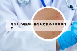 身體上長癬是缺一種什么元素 身上長蘚缺什么