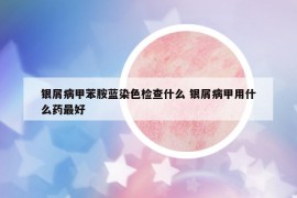 銀屑病甲苯胺藍(lán)染色檢查什么 銀屑病甲用什么藥最好