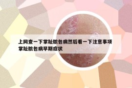 上網查一下掌趾膿包病然后看一下注意事項 掌趾膿包病早期癥狀