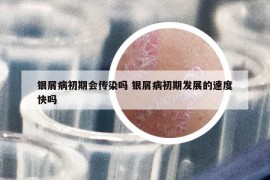 銀屑病初期會傳染嗎 銀屑病初期發(fā)展的速度快嗎