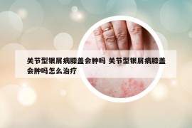 關(guān)節(jié)型銀屑病膝蓋會腫嗎 關(guān)節(jié)型銀屑病膝蓋會腫嗎怎么治療