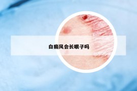 白癜風(fēng)會(huì)長(zhǎng)眼子嗎