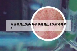 牛皮癬用鹽洗頭 牛皮膚癬用鹽水洗有好處嘛?
