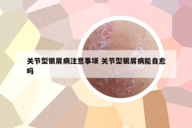 關(guān)節(jié)型銀屑病注意事項(xiàng) 關(guān)節(jié)型銀屑病能自愈嗎