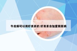 牛皮癬可以用蝦青素的 蝦青素會(huì)加重銀屑病